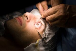 What Is LASIK Eye Surgery?