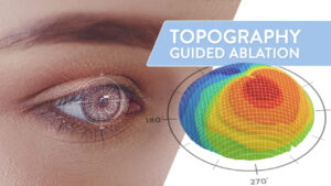What Is Topography-Guided LASIK?