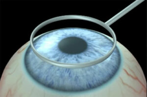 What is Flapless Lasik Surgery?