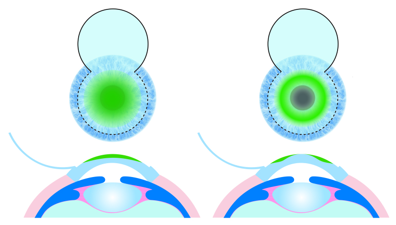 Hyperpic Hyperopic LASIK: Detailed Guide About This Type of LASIK