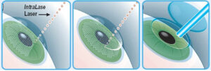 What is Intralase LASIK?