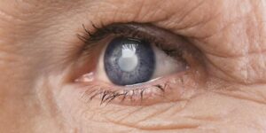What is Presenile Cataract