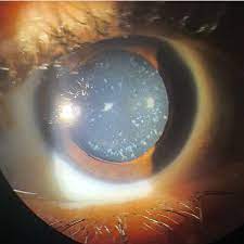 What is a Punctate Cataract