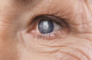 What is a Right Eye Cataract?