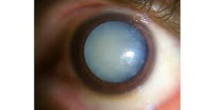 What is a Senile Cataract?