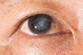 What is a Traumatic Cataract?