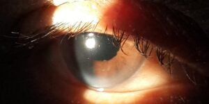 What Is Posterior Subcapsular Cataract?