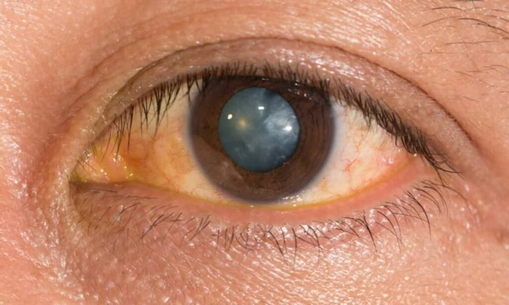 What Is Posterior Subcapsular Cataract? Things You Need To Know