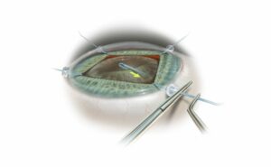 What Is Iris Hooks Cataract Surgery?