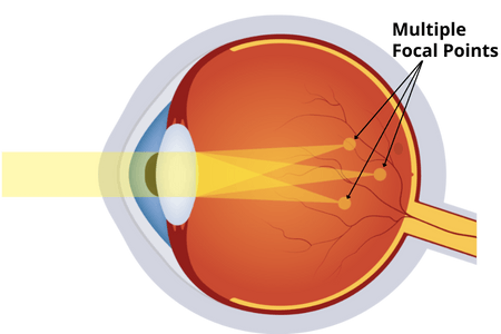 astigmatism vision lasik