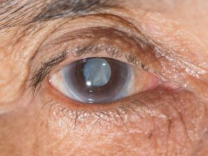How Is Sorbitol Cataract Diagnosed?