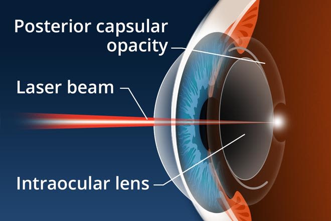 Causes, Symptoms and Treatment of Capsular Cataracts