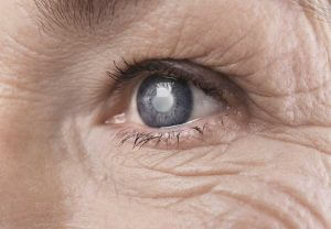 What is Keyhole Cataract Surgery?