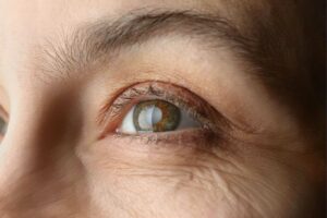 What Are The Risk Factors For Developing Cataracts?