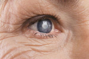 How To Reduce Your Risk Of Developing This Cataract?
