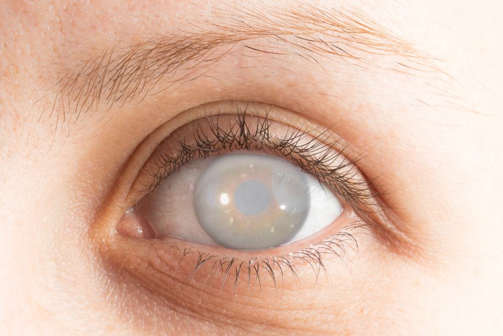 The Complete Guide to the Various Options for Congenital Cataract Treatment