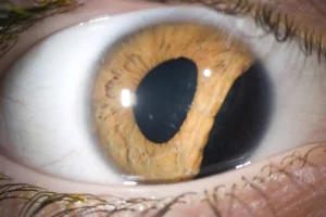 How Can You Treat Complicated Cataracts?