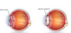 What You Need to Know About Cataracts