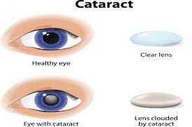 What Is a Cataract?