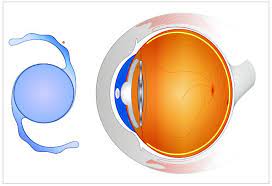 Different Types Of Cataract Lenses IOL