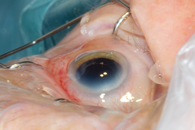 Cataracts: What You Need To Know About Diagnosis And Treatment Options
