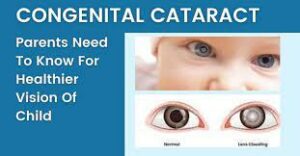 What is Congenital Cataract Treatment?