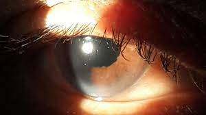 What Is Cortical Cataract?
