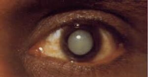 Symptoms of Atopic Cataract