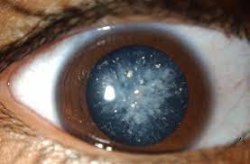 What Is Blue Dot Cataract?