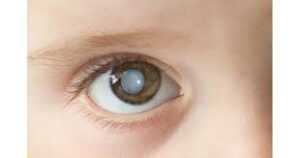 What Is A Developmental Cataract?
