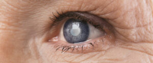 What Are Snowstorm Cataracts? How Can You Treat