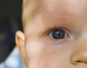 What Are The Risks Associated With Juvenile Cataract Surgery?