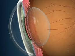 What Is Hydrophobic Lens for Cataracts?