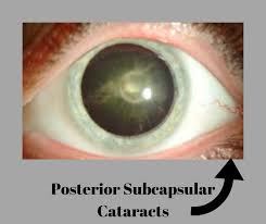 What Is Capsular Cataract?