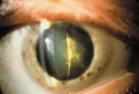 What Is a Central Cataract?