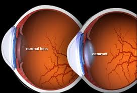 What Are the Symptoms of Coronary Cataracts?