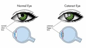 What You Need to Know About the New Hydrophobic Lens for Cataract