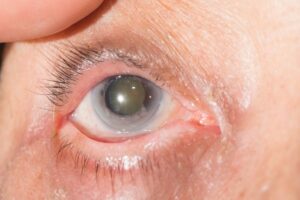 What Is Sclerotic Cataract?