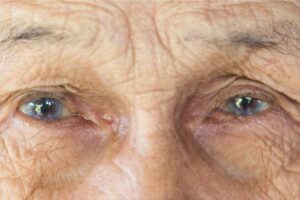 How Are Dense Cataracts Treated?