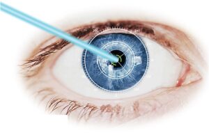 What Is Femtosecond Laser Cataract Surgery?