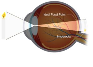 What is Hypermetropia (Farsightedness)? Things You Should Know