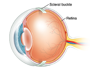 cross sectioned eye showing scleral buckle