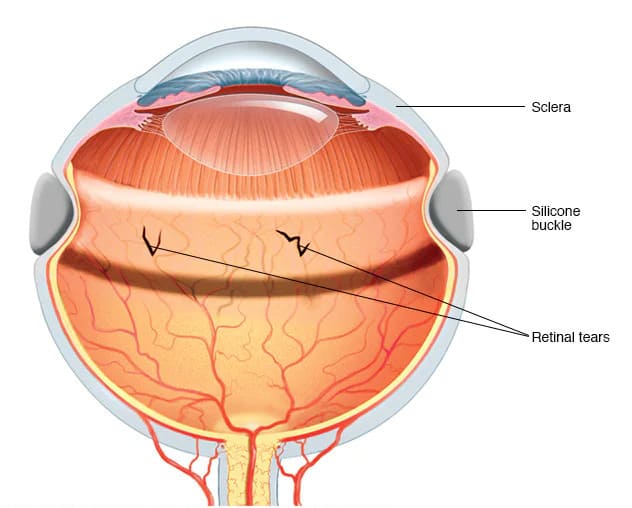 scleral buckling