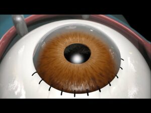 Coronary Cataract: What It Is And How It Is Treated?