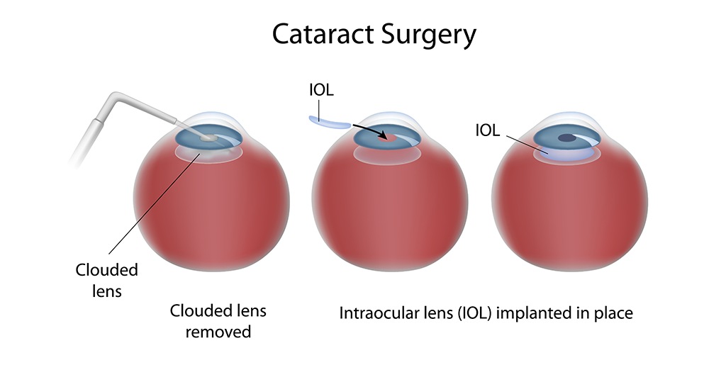 Intracapsular Cataract Extraction: Everything You Need to Know
