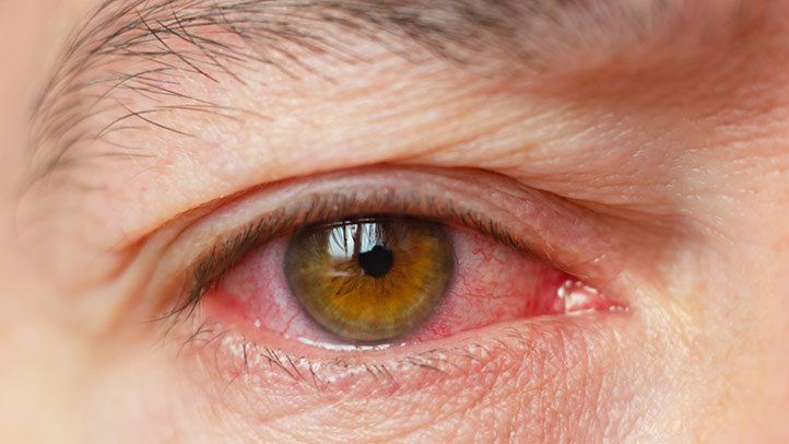 Sutural Cataracts: Causes, Symptoms, and Treatment