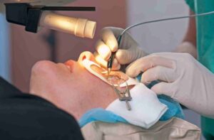 Lasik surgery