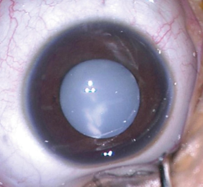 Metabolic Cataract: What It Is And How It's Treated