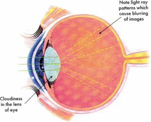 What Is Galactosemia Cataract And How Can You Prevent It?