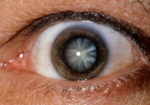 Glass Blowers Cataract: What It Is And How It's Treated